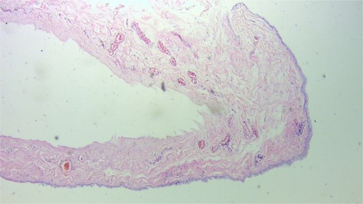 Photomicrograph of cyst ×10 magnification.