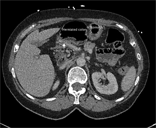 An axial slice from the pre-operative CT abdomen pelvis in portal venous phase. There is an arrow pointing to narrowed appearance of portal vein. Also labeled are the herniated colon anteriorly and the stomach to the left of the herniated colon.