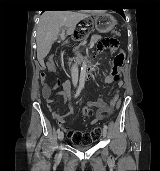 A coronal slice from the pre-operative CT abdomen pelvis in portal venous phase, with text labeling the herniated colon and differentiating this from the stomach.