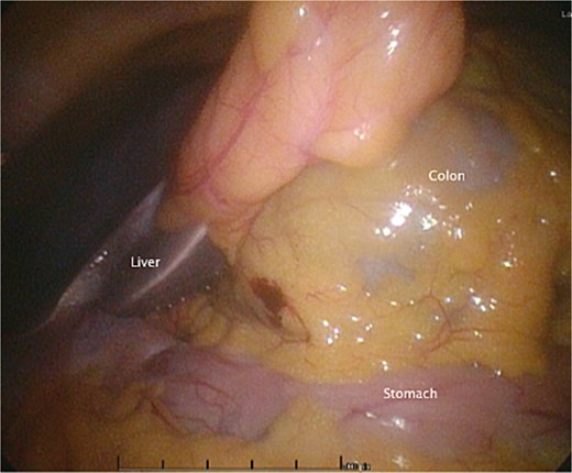 An intraoperative photo during the initial laparoscopic part of the surgery, demonstrating the colon herniating through the foramen of Winslow.