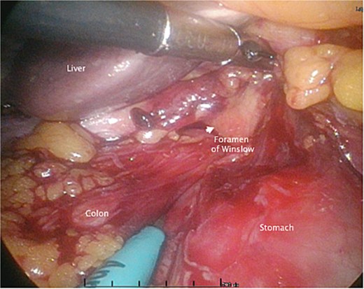 An intraoperative photo during the initial laparoscopic part of the surgery, demonstrating the colon herniating through the foramen of Winslow.
