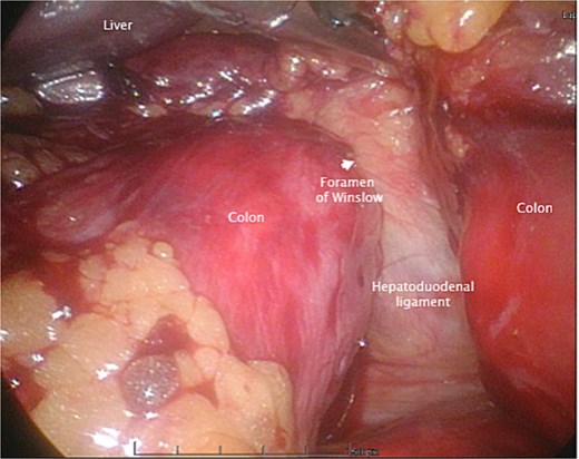An intraoperative photo during the initial laparoscopic part of the surgery, demonstrating the colon herniating through the foramen of Winslow.