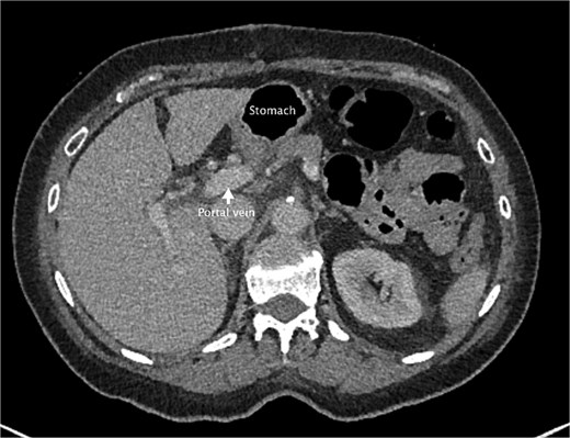 An axial slice from the post-operative CT abdomen pelvis in portal venous phase. There is an arrow pointing to the portal vein that has returned to normal size. Also labeled is the stomach now lying anteriorly rather than the colon.