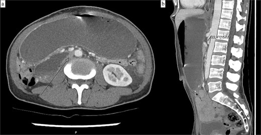 (a) Axial CT demonstrating a grossly distended stomach, first and second duodenal segments with collapse at the third segment between the abdominal aorta and SMA. (b) Sagittal CT with a measured aorto-mesenteric angle of 22°.