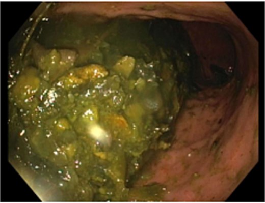 Bezoar material in the gastric body with associated erosive gastritis.