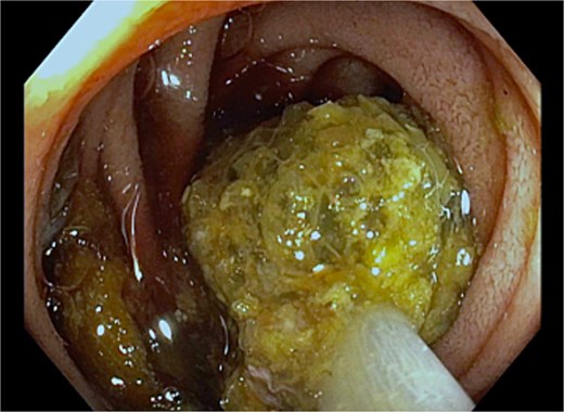 Bezoar material at the duodenojejunal flexure.
