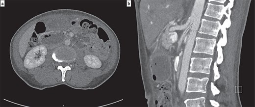 (a) Axial CT showing interval resolution of gastric dilatation with ongoing narrowing of the third duodenal segment between the aorta and SMA. (b) The aorto-mesenteric angle remains reduced at 22° on sagittal CT.