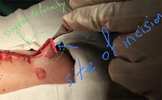 The initial incision site was marked at the apex of the dog-ear deformity.