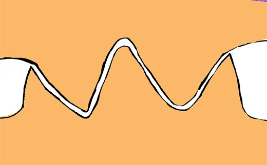 Properly aligned tissue edges interlock securely, ensuring a stable, tension-free closure that preserves both functional and aesthetic outcomes.