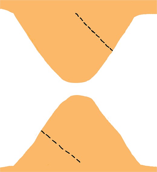 Incisions are made from the midpoint of the lateral edge to the midpoint of the base on one triangular flap, mirrored on the contralateral triangular flap to facilitate symmetrical reconstruction.