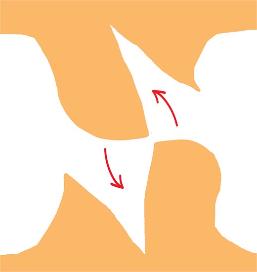 Transposition of the arrow-shaped portion of each flap into the contralateral wedge defect with slight rotation, ensuring optimal contour, tension distribution, and preservation of vascular integrity.