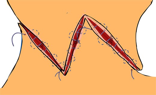 Final positioning and fixation of the flaps using non-absorbable sutures. Interrupted or horizontal mattress sutures are placed along the wound margins to ensure proper alignment, reduce tension, and enhance both functional and aesthetic outcomes.