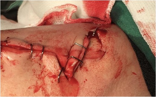 Postoperative clinical image showing the final positioning and suturing of the flap in an actual patient. Image used with written informed consent. Identifying details have been omitted to protect patient confidentiality.