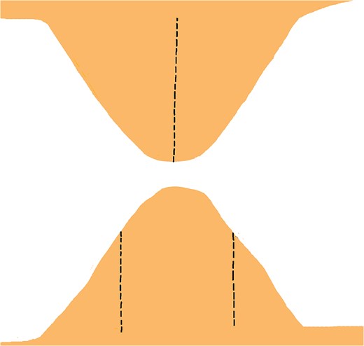 Vertical incision made from the apex to the base on one flap, and two identical incisions on the contralateral flap, positioned one-third from the apex along the lateral edges, extending straight and parallel to the triangle’s altitude down to the base.