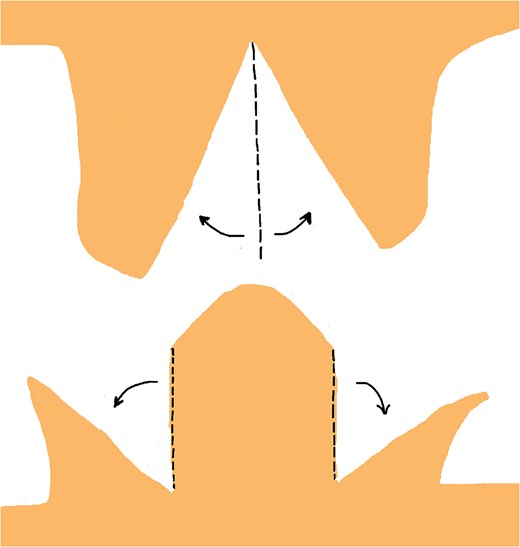 Retraction of the wedge defects to allow precise fitting of the arrow-shaped prominences into their corresponding defects, ensuring proper alignment without excessive tension.