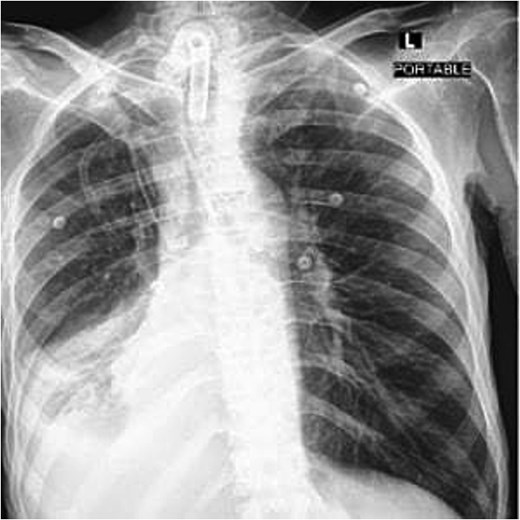 Post-operative frontal portable chest radiograph showing a tracheostomy tube in position above the carina.