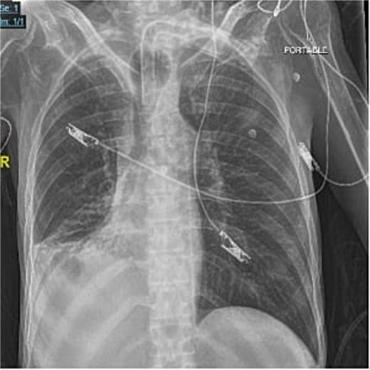 Frontal portable chest radiograph showing a tracheostomy tube in satisfactory position above the carina, however, there is a rounded radiolucency at the expected position of the tracheostomy cuff suggestive of tracheostomy tube cuff overinflation. Additionally, there is a small right pleural effusion with adjacent atelectatic changes/ consolidation.