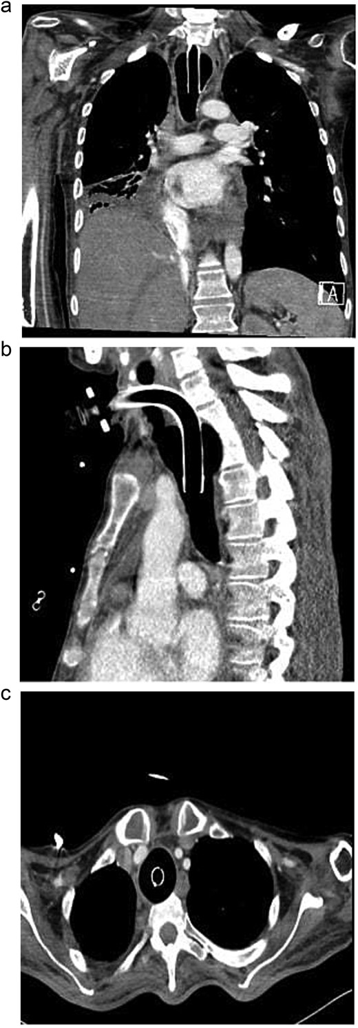 Axial contrast-enhanced chest CT with reformatted coronal and sagittal images showing fusiform dilation of the trachea with scalloping of the anterior surface of thoracic vertebral bodies. Moreover, no appreciable separating soft tissue layer between the tracheostomy cuff and the anterior surface of vertebral bodies.
