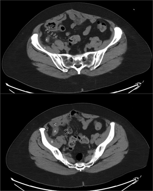 Axial images of CT scan with IV contrast showing appendix within retrocecal position in proximity within iliacus space. (A) Appendix; (B) iliacus muscle; (C) cecum.