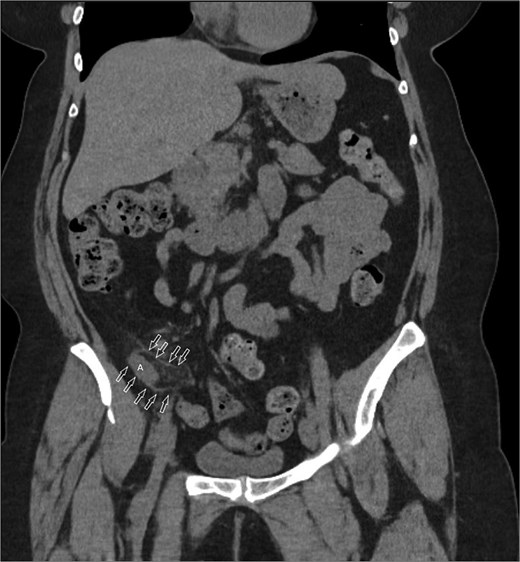 Coronal image CT scan with IV contrast with arrows denoting appendix in proximity to iliacus space. (A) Appendix.