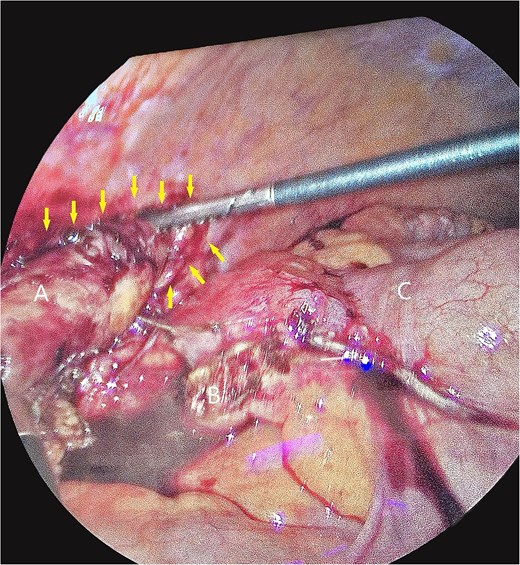 Intra-operative photos of appendix contained within iliacus hernia after appendix was divided. The arrows showcase the hernia with appendix. (A) Appendix, (B) mesoappendix after division, (C) cecum with staple line.