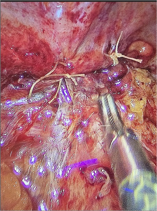 Iliacus hernia defect closed primarily after appendix was removed.