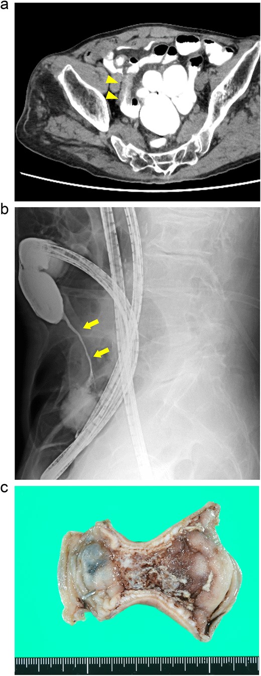Case 1: (a) CT enterography with water-soluble contrast agent. The arrowheads indicate a segmental stricture with wall thickening in the distal ileum. (b) Fluoroscopy during double-balloon endoscopy. The arrows indicate a segmental, smooth luminal narrowing in the distal ileum. (c) Macroscopic view of the resected specimen. Circumferential ulceration is visible in the affected area.