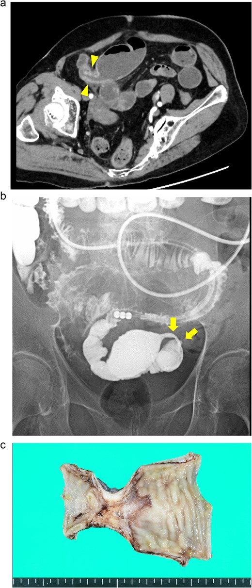 Case 2: (a) Contrast-enhanced CT of the abdomen. The arrowheads indicate segmental luminal stricture with wall thickening in the distal ileum. (b) Fluoroscopy with a long intestinal tube. The arrows indicate a segmental, smooth luminal narrowing in the distal ileum. (c) Macroscopic view of the resected specimen. Circumferential ulceration and surrounding fibrosis are visible in line with the stenotic site.