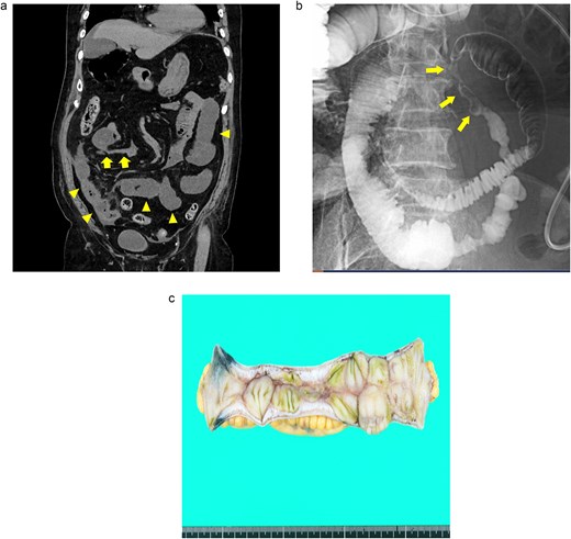 Case 3: (a) Plain CT of the abdomen. The arrows indicate a segmental stricture in the distal ileum. The arrowheads indicate dilatation of the small bowel. (b) Fluoroscopy with a long intestinal tube. The arrows indicate segmental, irregular, patchy luminal narrowing of the distal ileum. (c) Macroscopic view of the resected specimen. Multiple longitudinal ulcers with irregular wall thickening are visible in the affected areas.