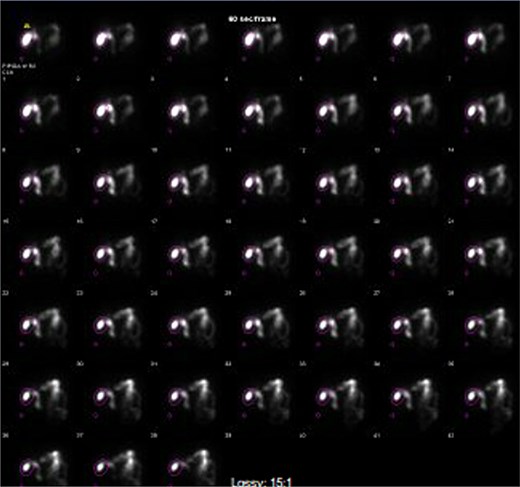 HIDA scan showing normal gallbladder filling and rapid emptying of nucleotide contrast in the SB following administration of CCK.