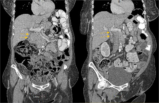 Hyperdense material (arrows) found in the CBD on the post-HIDA CT (right) that was not previously seen on the pre-HIDA CT on admission (left).