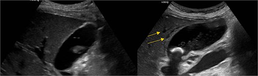 Pericholecystic fluid (arrows) and positive sonographic murphy sign present on the post-HIDA ultrasound (right) that was not previously seen on the pre-HIDA ultrasound on admission (left).