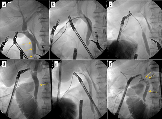 Intraoperative cholangiogram. (a) Initial cholangiogram via 6-fr ureteral stent showing multiple filling defects (arrows). (b) Guidewire passed through the ureteral stent and down to the level of the ampulla of vater, demonstrating complete CBD obstruction. (c) 7 × 40 mm vascular catheter balloon advanced over the guidewire and through the ampulla of vater. Dilated to nominal pressure. (d) Contrast now able to leave the CBD and into the duodenum. Residual “floating” filling defects still seen (arrows). (e) Vascular catheter exchanged for a 9 × 40 mm balloon and dilated to nominal pressure. (f) Completion cholangiogram shows brisk outflow of contrast with residual filling defects (arrows).