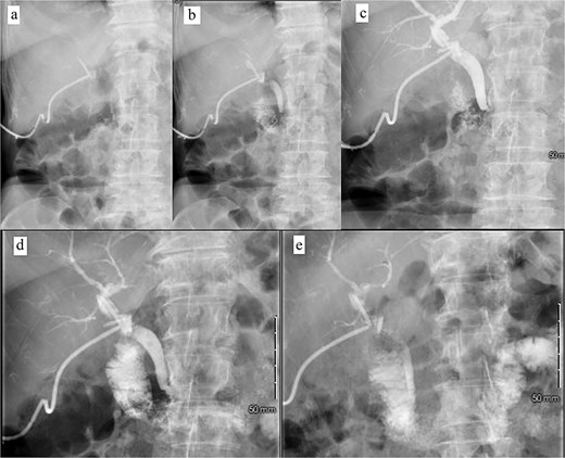 Postoperative tube study in ER. (a) Contrast injected into the cholecystostomy tube. (b) Contrast entering the CBD. (c) Contrast completely filling the CBD and intrahepatic ducts. (d) Contrast leaving the CBD and into the duodenum. (e) Contrast predominately in the small bowel.