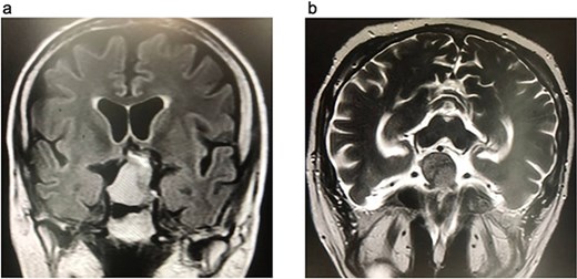 Brain MRI. (a) FLAIR coronal section. (b) T2WI axial section, show pituitary macroadenoma, measuring 35 × 27 × 25 mm. The sellar mass expands the sella and extends into suprasellar region, exhibiting a heterogeneous signal. It is in contact with optic chiasm and partially encases internal carotid artery (ICA).