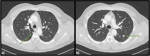 Axial CT scan of the chest indicating (a) lobulated lesion in apical segment of right lower lobe (9 × 10 × 10 mm) and (b) secondary lobulated lesion present in left lower lobe (15 × 11 × 14 mm).