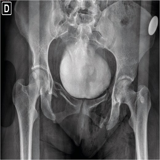 Preoperative pelvic X-ray.