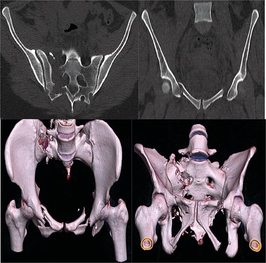 Preoperative CT scan of pelvic fracture.