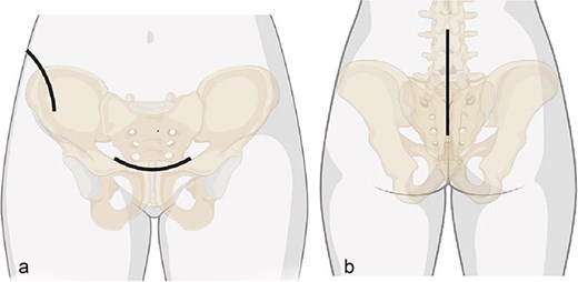 Surgical approaches diagram: (a) anterior approach; (b) posterior approach.