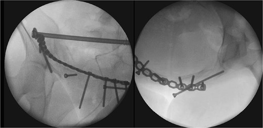 Postoperative X-ray (first stage).