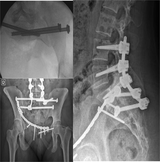 Postoperative X-ray (second stage).