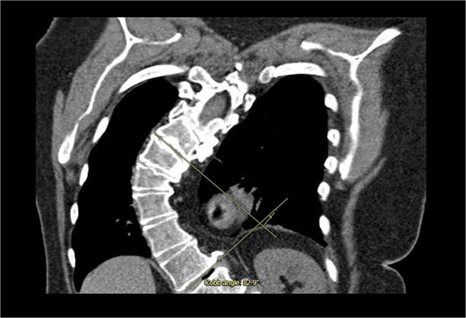 Coronal computed tomography (CT) with measurement of the cobb angle.