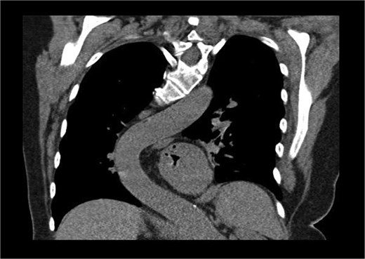 Coronal CT showing curvature of the thoracic aorta tortuosity compressing the distal esophagus and causing chronic left lower lobe segmental atelectasis.