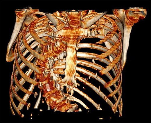 Pre-operative 3D reconstruction of patients thorax from CT.