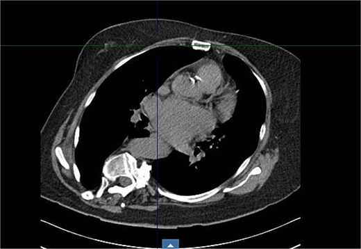 Axial CT at level of 2nd ICS.