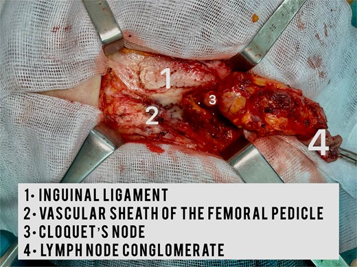 Intraoperative image showing the lymph node conglomerate.