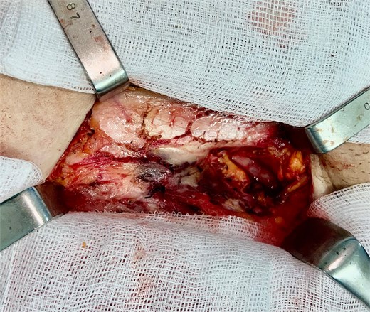 Intraoperative image after resection.