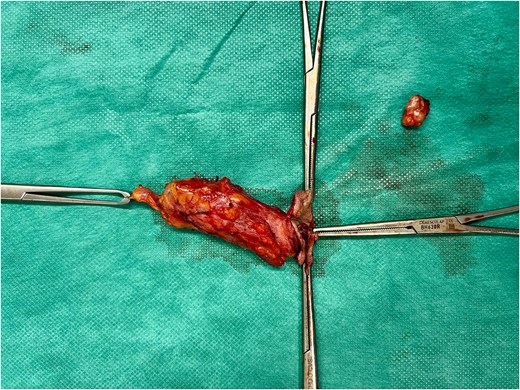 Surgical specimen.