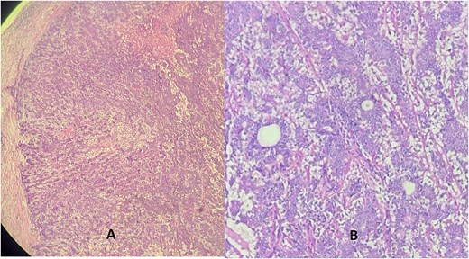 Hematoxylin eosin stain (A = ×10) (B = ×40) showing a well-defined tumor made of a dual component forming glands: One layer next to the glandular lumen = epithelial layer made of rounded cells with eosinophilic cytoplasm, resting on the myoepithelial layer whose cells are spindle-shaped with an elongated nucleus.