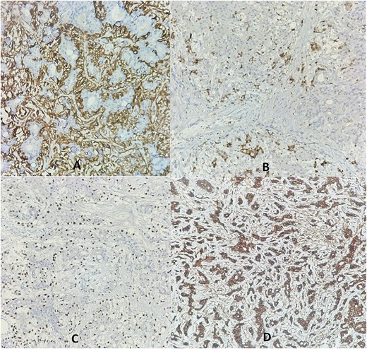 Immunohistochemistry revealed membranous staining for SMA (A), cytoplasmic staining for PS100 (B), and nuclear staining for P63 (C) in the myoepithelial layer cells, while the epithelial layer cells showed cytoplasmic staining for cytokeratin AE1/AE3 (D).